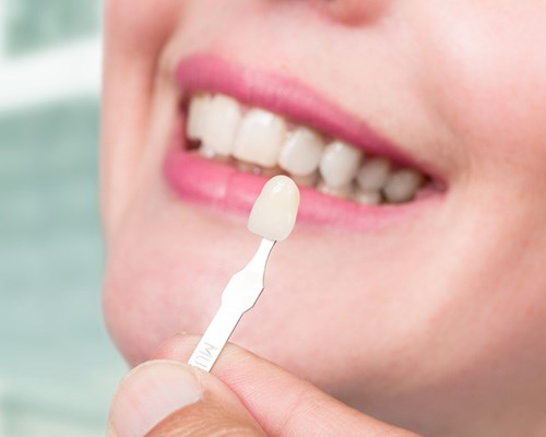 Faccette Dentali